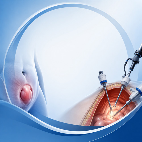 Hernia Warning Signs You Should Not Ignore